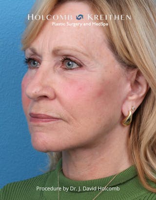 Facelift Before & After Gallery - Patient 284851 - Image 8