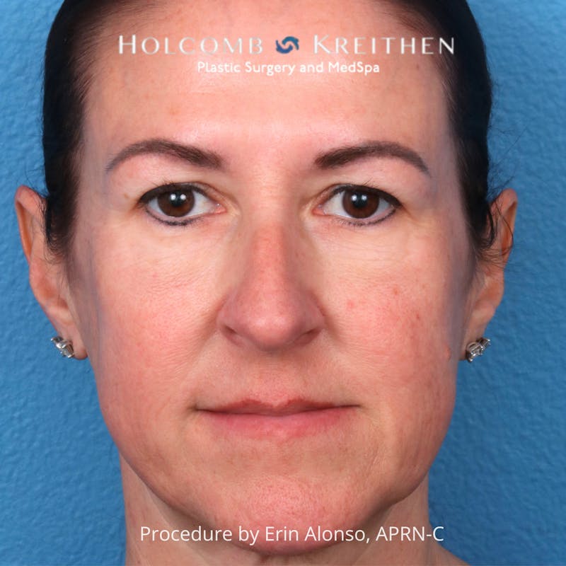 Excel V Before & After Gallery - Patient 201878 - Image 2