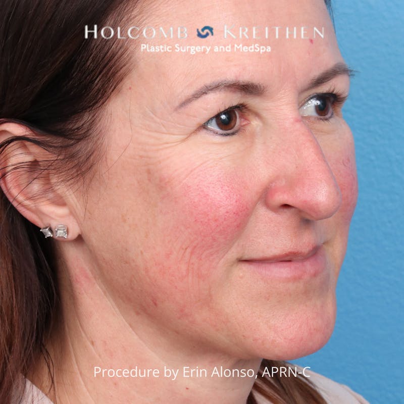 Excel V Before & After Gallery - Patient 201878 - Image 3