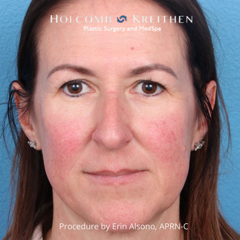 Excel V Before & After Gallery - Patient 201878 - Image 1
