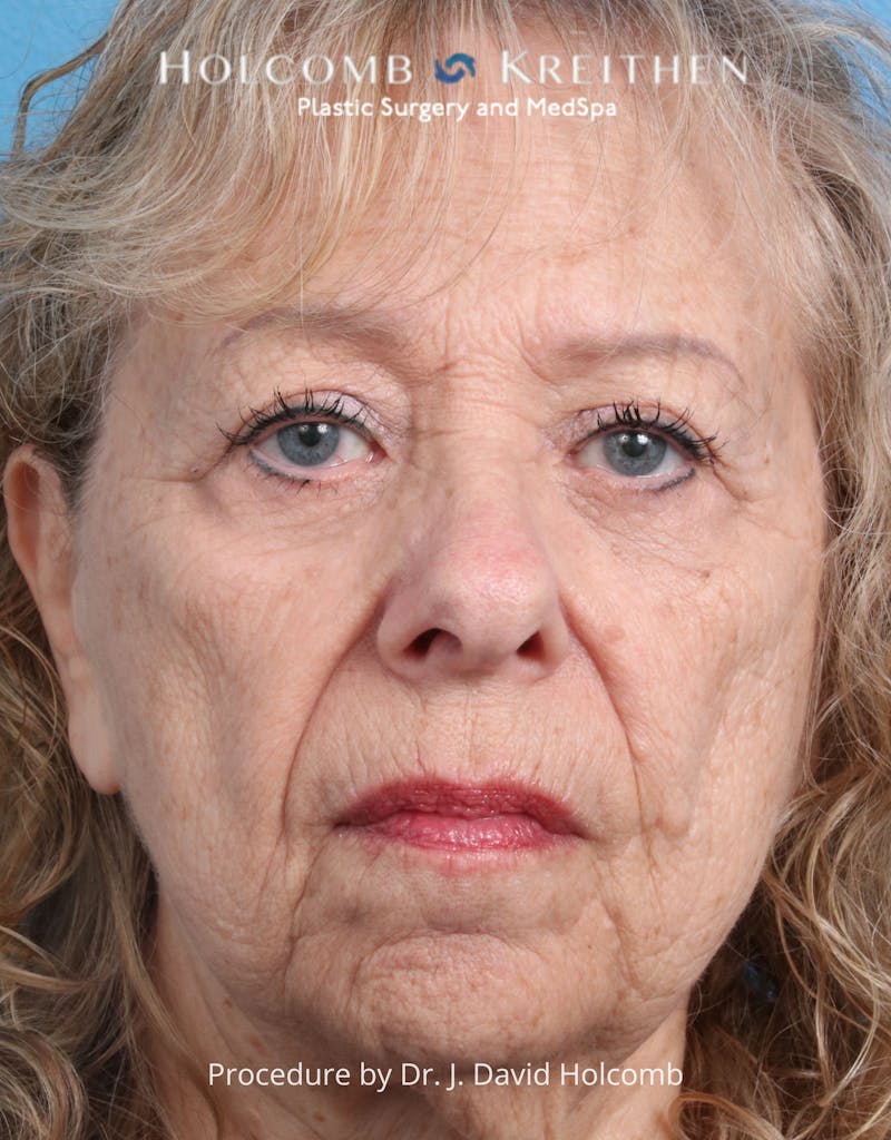 Browlift Before & After Gallery - Patient 233586 - Image 1