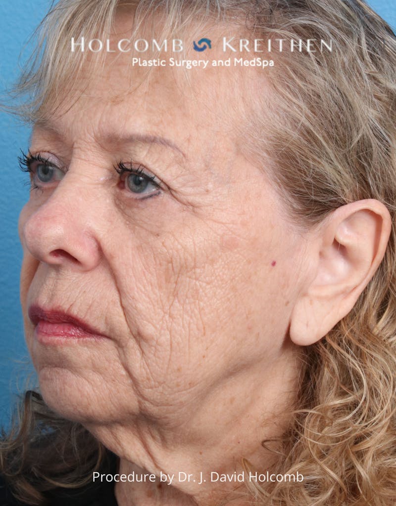 Browlift Before & After Gallery - Patient 233586 - Image 7