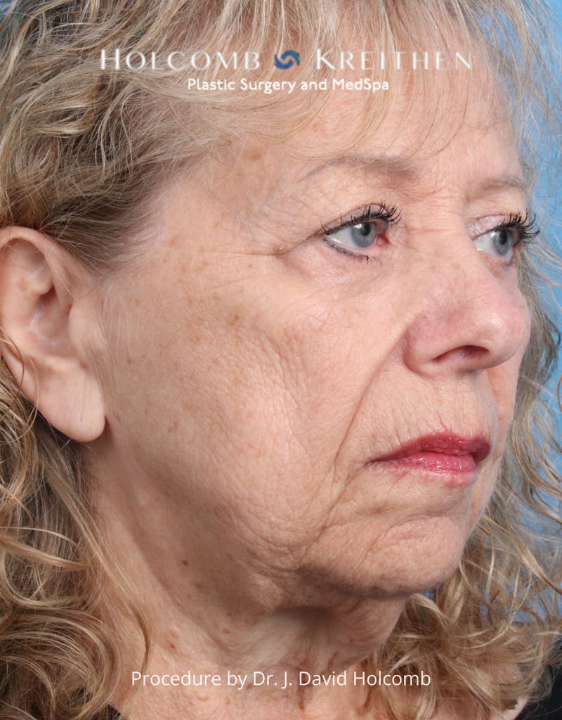 Browlift Before & After Gallery - Patient 233586 - Image 3