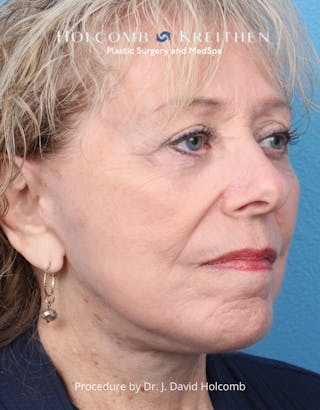 Facelift Before & After Gallery - Patient 198051 - Image 4