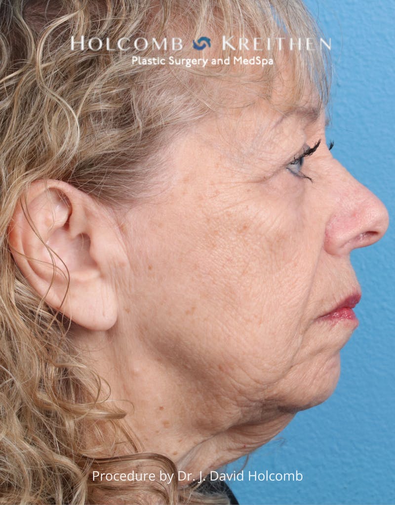 Browlift Before & After Gallery - Patient 233586 - Image 5