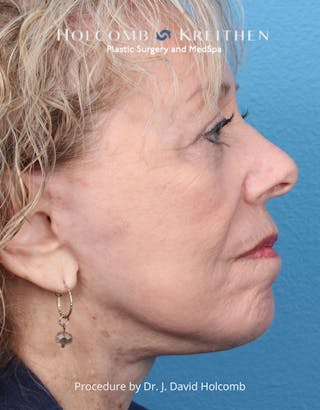 Facelift Before & After Gallery - Patient 198051 - Image 6