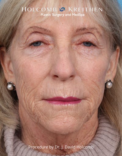 Facelift Before & After Gallery - Patient 105326 - Image 1