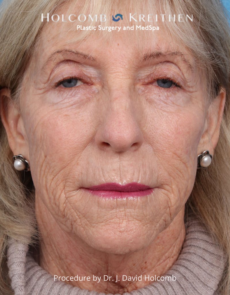 Facelift Before & After Gallery - Patient 105326 - Image 1