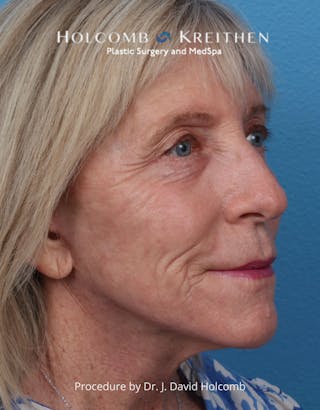 Ultraclear Before & After Gallery - Patient 282278 - Image 4