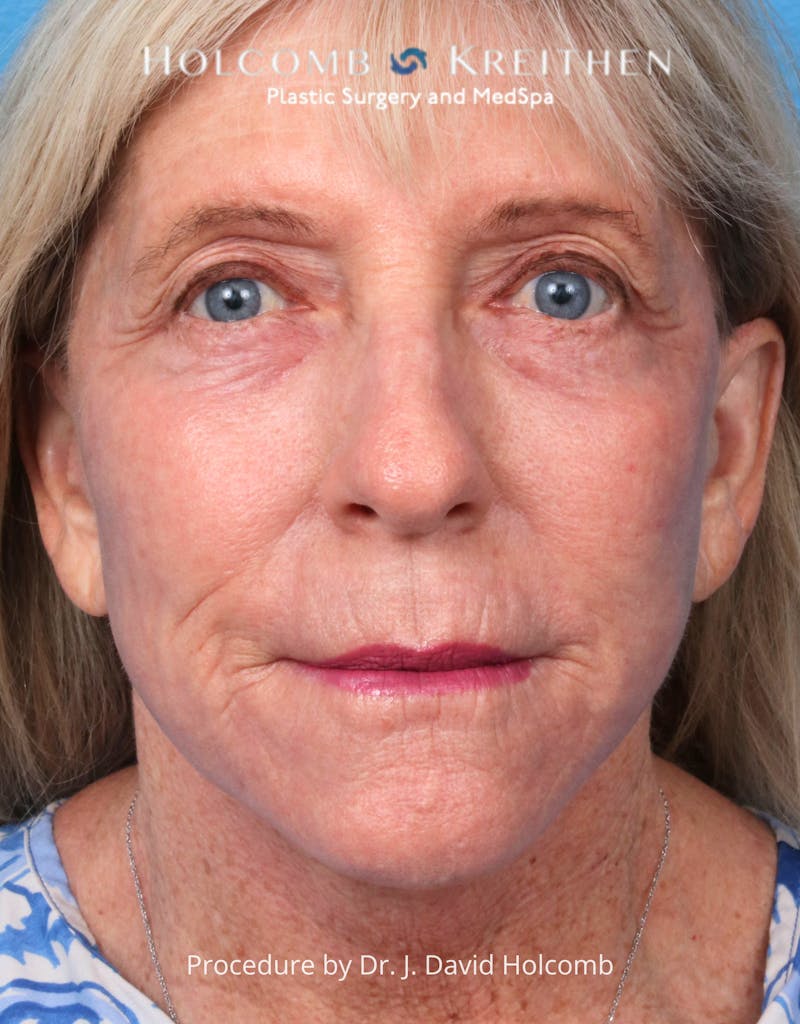Facelift Before & After Gallery - Patient 105326 - Image 2