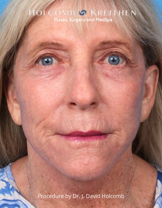 Ultraclear Before & After Gallery - Patient 282278 - Image 2