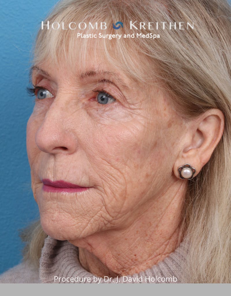 Facelift Before & After Gallery - Patient 105326 - Image 5