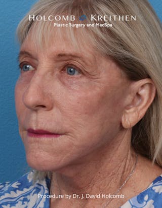 Ultraclear Before & After Gallery - Patient 282278 - Image 6