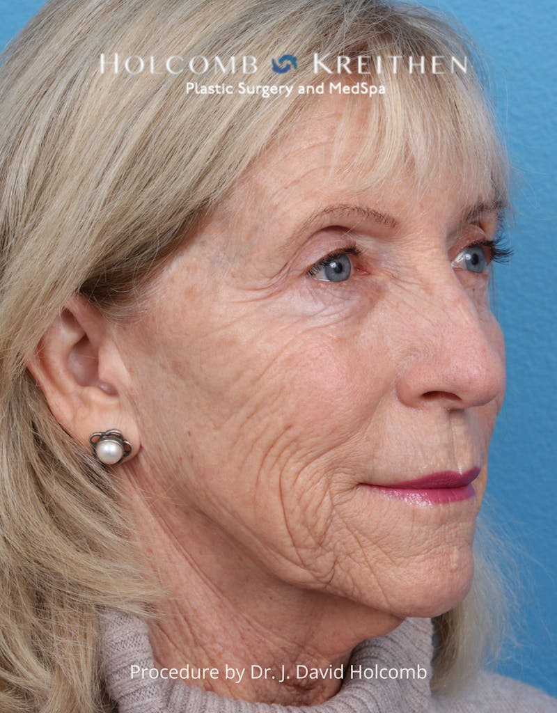 Facelift Before & After Gallery - Patient 105326 - Image 3