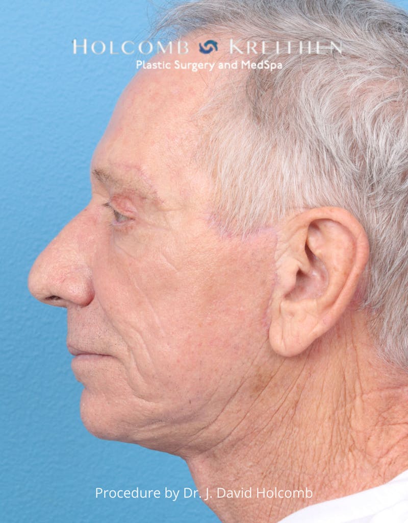 Blepharoplasty Before & After Gallery - Patient 335692 - Image 4