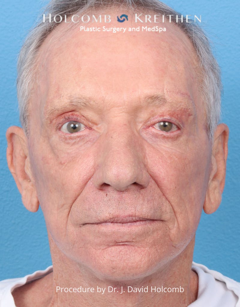 Blepharoplasty Before & After Gallery - Patient 335692 - Image 2