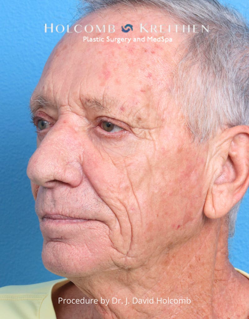 Blepharoplasty Before & After Gallery - Patient 335692 - Image 5