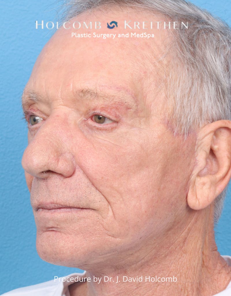 Blepharoplasty Before & After Gallery - Patient 335692 - Image 6