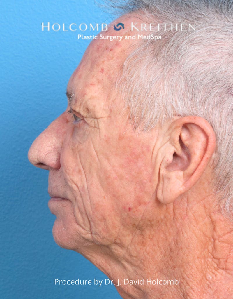 Blepharoplasty Before & After Gallery - Patient 335692 - Image 3