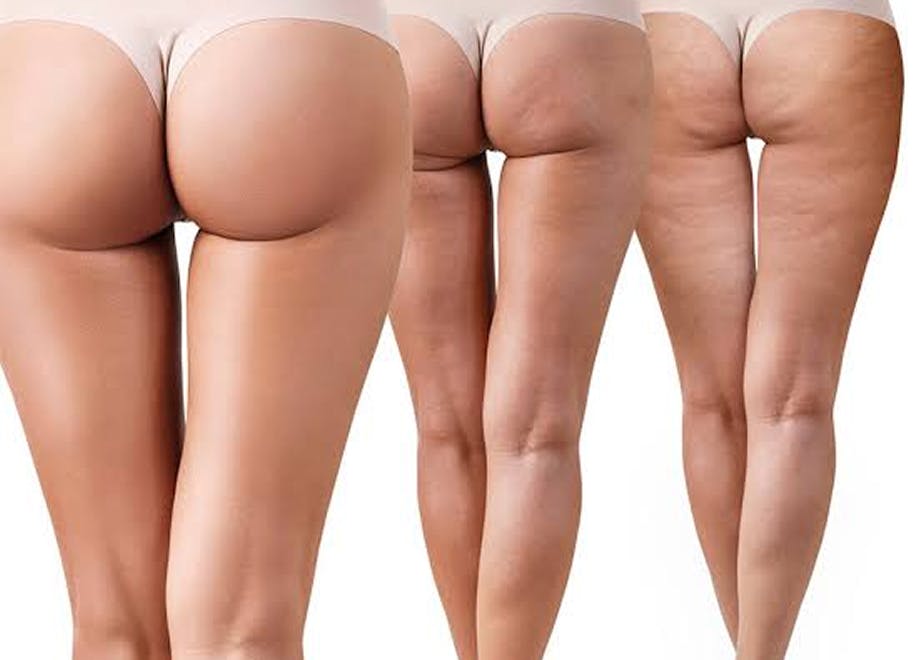 Holcomb – Kreithen Plastic Surgery and MedSpa (HKPS) Will Become the First Sarasota – Bradenton Area Practice Offering Cellfina™ Cellulite Treatment