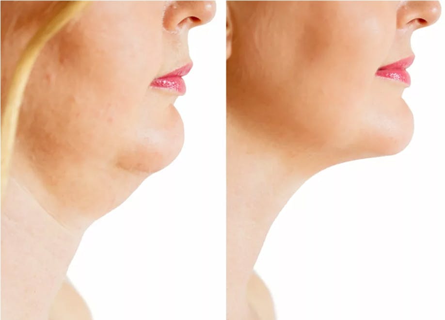 Kybella is now available at Holcomb - Kreithen Plastic Surgery and MedSpa