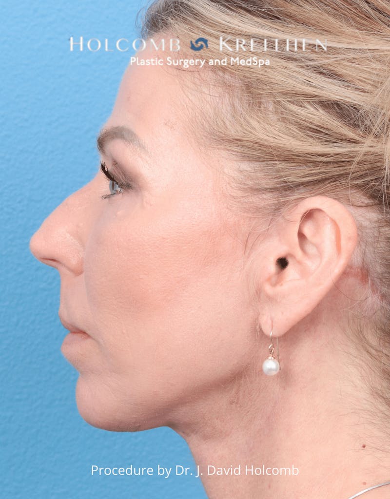 Ultraclear Before & After Gallery - Patient 257193 - Image 6