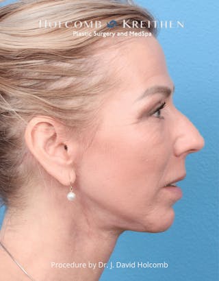 Ultraclear Before & After Gallery - Patient 257193 - Image 8