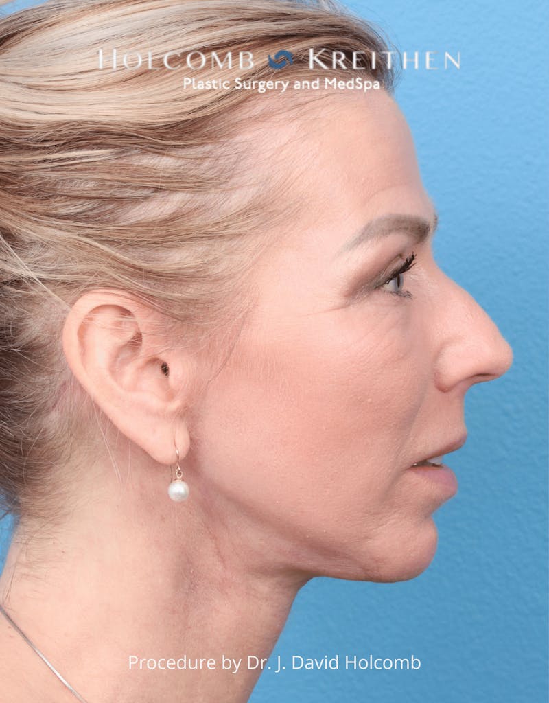 Ultraclear Before & After Gallery - Patient 257193 - Image 8
