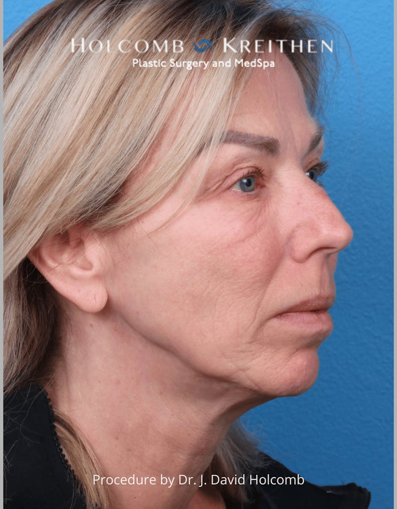 Ultraclear Before & After Gallery - Patient 257193 - Image 9