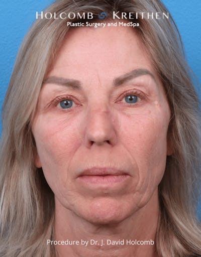Ultraclear Before & After Gallery - Patient 257193 - Image 1
