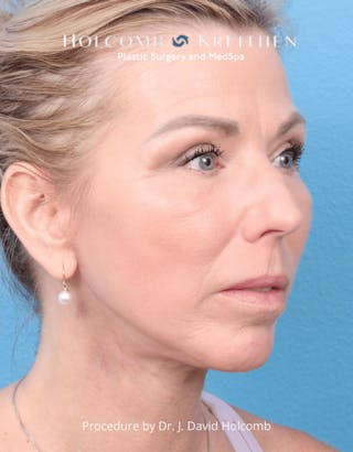 Ultraclear Before & After Gallery - Patient 257193 - Image 10