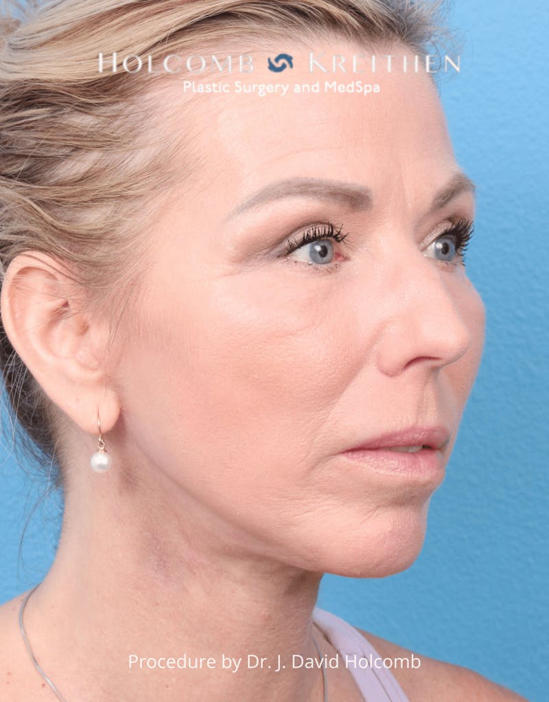 Ultraclear Before & After Gallery - Patient 257193 - Image 10