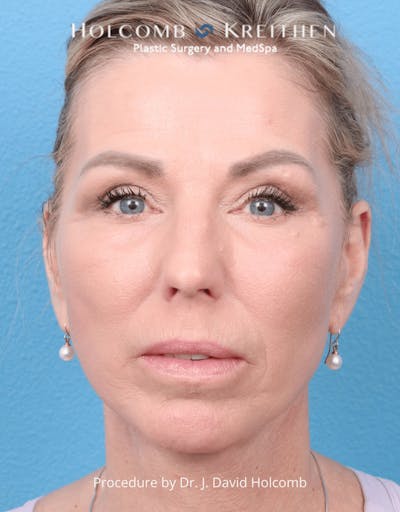 Ultraclear Before & After Gallery - Patient 257193 - Image 2