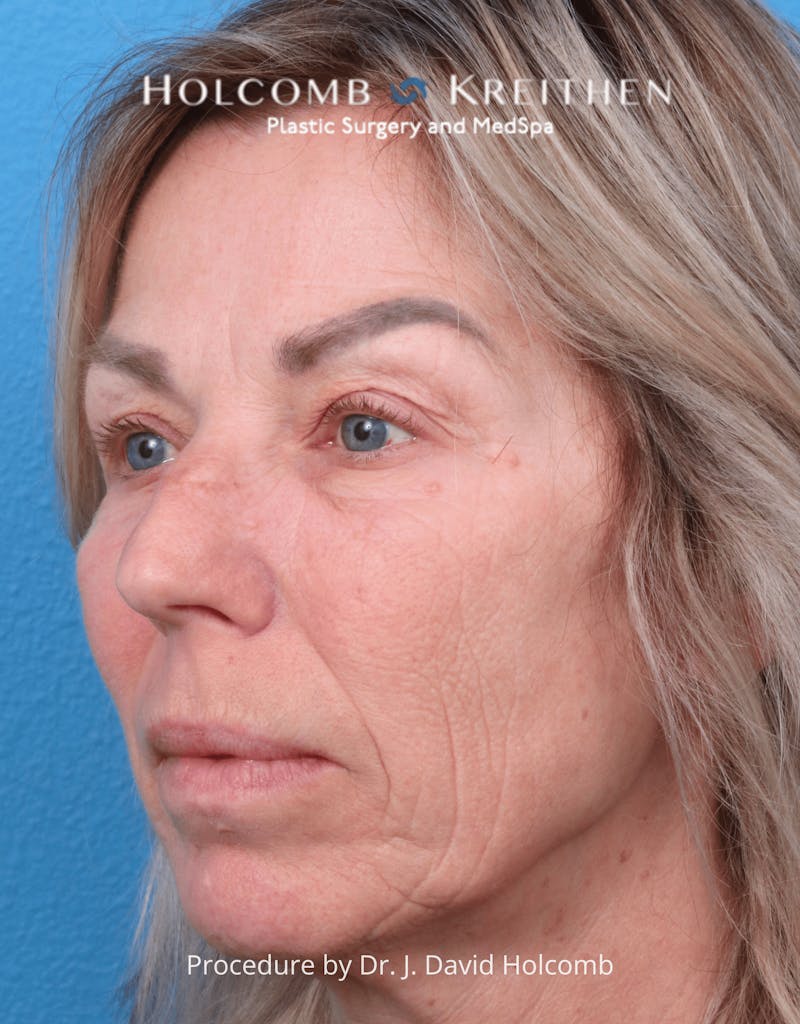 Ultraclear Before & After Gallery - Patient 257193 - Image 3