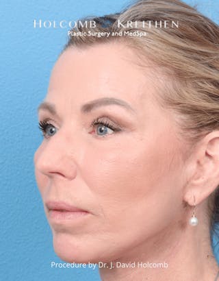 Ultraclear Before & After Gallery - Patient 257193 - Image 4