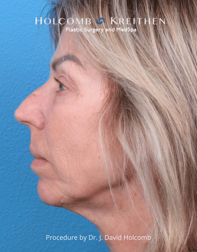 Ultraclear Before & After Gallery - Patient 257193 - Image 5