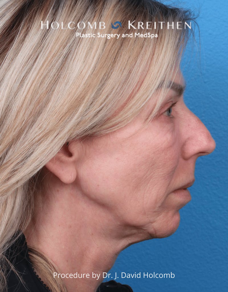 Ultraclear Before & After Gallery - Patient 257193 - Image 7