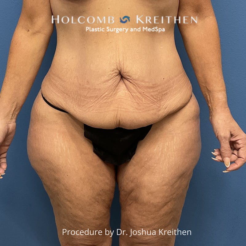 Lower Body Lift Before & After Gallery - Patient 306091 - Image 1