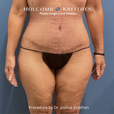 Lower Body Lift Before & After Gallery - Patient 306091 - Image 2