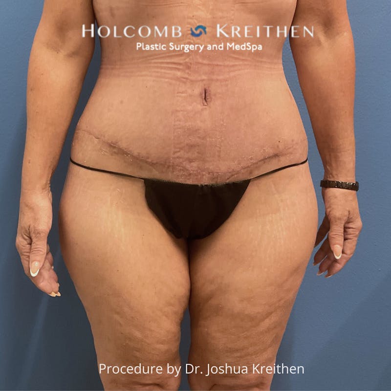 Lower Body Lift Before & After Gallery - Patient 306091 - Image 2