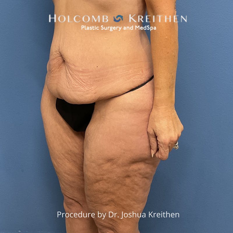 Lower Body Lift Before & After Gallery - Patient 306091 - Image 3