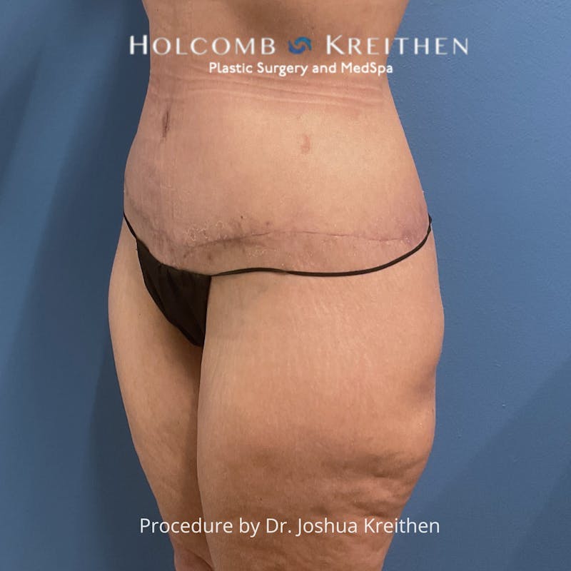 Lower Body Lift Before & After Gallery - Patient 306091 - Image 4