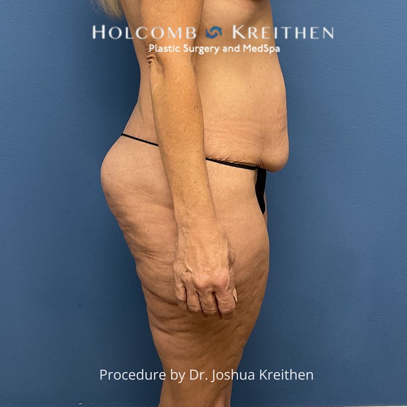 Lower Body Lift Before & After Gallery - Patient 306091 - Image 5