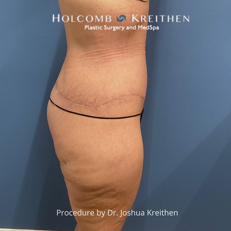 Lower Body Lift Before & After Gallery - Patient 306091 - Image 6