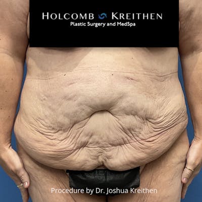 Lower Body Lift Before & After Gallery - Patient 189380 - Image 1