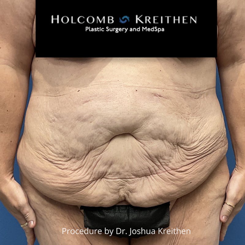 Lower Body Lift Before & After Gallery - Patient 189380 - Image 1