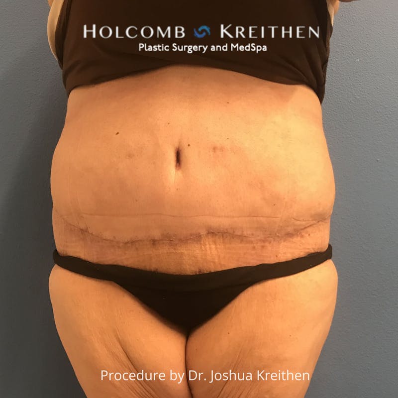 Lower Body Lift Before & After Gallery - Patient 189380 - Image 2