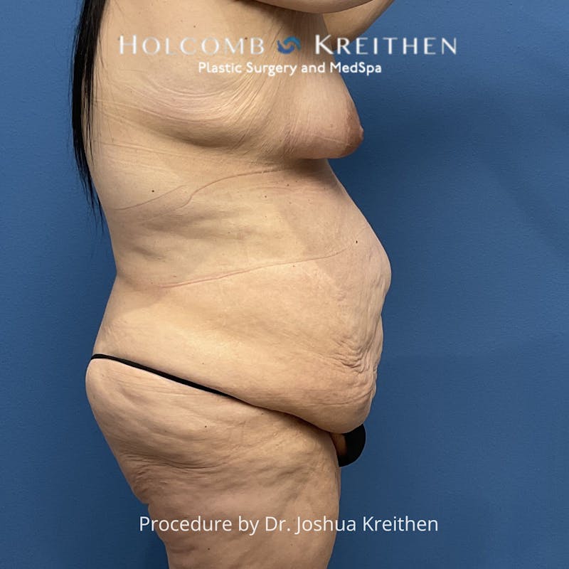 Lower Body Lift Before & After Gallery - Patient 189380 - Image 3