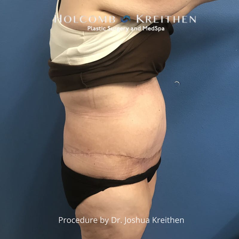 Lower Body Lift Before & After Gallery - Patient 189380 - Image 4