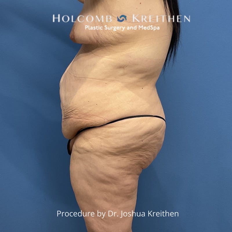 Lower Body Lift Before & After Gallery - Patient 189380 - Image 5